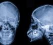 Имал страшни главоболки, докторите откриле чуден предмет во неговиот череп (ФОТО)