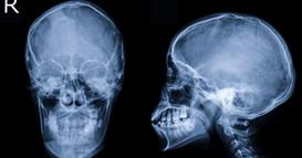 Имал страшни главоболки, докторите откриле чуден предмет во неговиот череп (ФОТО)